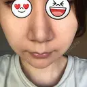 鼻尖形成（切開） / ヒアルロン酸注入（鼻） 東京ヒルズクリニック 新宿院 DAY 38 サムネイル用