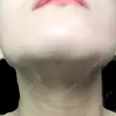 骨切り（あご） / 脂肪吸引（顔） / ボトックス（エラ・小顔） 銀座マイアミ美容外科 DAY 59 サムネイル用