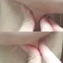 骨切り（あご） / 脂肪吸引（顔） / ボトックス（エラ・小顔） 銀座マイアミ美容外科 DAY 59 サムネイル用