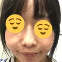 小鼻縮小（切開） / その他（鼻） 湘南メディカル記念病院（両国） DAY 34 サムネイル用