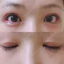 二重切開 / 眼瞼下垂（切開） / 目尻切開 ジュエリー美容外科 DAY 16 サムネイル用