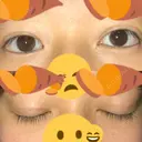 二重埋没 / 自然癒着法 表参道スキンクリニック 名古屋院（DAILY SKIN CLINIC提携院） AFTER サムネイル用