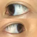 二重埋没 / 自然癒着法 表参道スキンクリニック 名古屋院（DAILY SKIN CLINIC提携院） DAY 26 サムネイル用