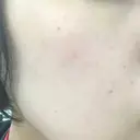 ピーリング（ニキビ・毛穴） 自由が丘クリニック DAY 2 サムネイル用