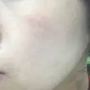 ピーリング（ニキビ・毛穴） 自由が丘クリニック DAY 2 サムネイル用