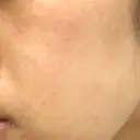 ピーリング（ニキビ・毛穴） 自由が丘クリニック DAY 10 サムネイル用