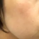 ピーリング（ニキビ・毛穴） 自由が丘クリニック DAY 10 サムネイル用