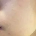 ピーリング（ニキビ・毛穴） 自由が丘クリニック DAY 15 サムネイル用