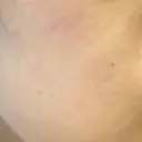 ピーリング（ニキビ・毛穴） 自由が丘クリニック AFTER サムネイル用