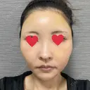 額を丸く / こめかみ形成 閉院｜プルージュ美容クリニック 赤羽院 DAY 5 サムネイル用