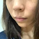ヒアルロン酸注入（あご） 植村美容外科 DAY 5 サムネイル用