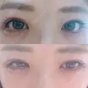 二重切開 / 眼瞼下垂（切開） / 目尻切開 ジュエリー美容外科 DAY 17 サムネイル用