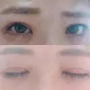 二重切開 / 眼瞼下垂（切開） / 目尻切開 ジュエリー美容外科 DAY 17 サムネイル用