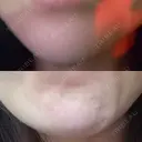 ボトックス（あご） 品川美容外科 仙台院 DAY 0 サムネイル用