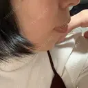 ガミースマイル手術 / 矯正（ワイヤー） / セラミック / ホワイトニング ラ・ブージュデンタルクリニック DAY 84 サムネイル用