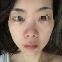 ハイフ（顔） 共立美容外科 仙台院 AFTER サムネイル用