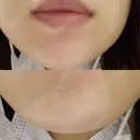 ボトックス（あご） 品川美容外科 仙台院 DAY 3 サムネイル用