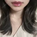 口唇縮小術 くさのたろうクリニック DAY 13 サムネイル用