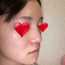 隆鼻術 / 鼻尖形成（切開） / 小鼻縮小（切開） / 軟骨移植 / 鼻翼基部形成（貴族手術） グローバルビューティークリニック 大阪院 DAY 69 サムネイル用