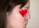 隆鼻術 / 鼻尖形成（切開） / 小鼻縮小（切開） / 軟骨移植 / 鼻翼基部形成（貴族手術） グローバルビューティークリニック 大阪院 AFTER サムネイル用