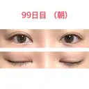 二重切開 水の森美容クリニック 東京新宿院 AFTER サムネイル用