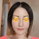 隆鼻術 / 鼻尖形成（切開） / 小鼻縮小（切開） / 軟骨移植 湘南美容クリニック 那覇院 AFTER サムネイル用