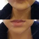 ボトックス（あご） 品川美容外科 仙台院 DAY 8 サムネイル用