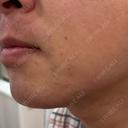 医療脱毛（顔） 自由が丘クリニック DAY 0 サムネイル用