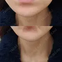 ボトックス（あご） 品川美容外科 仙台院 DAY 9 サムネイル用