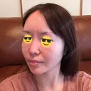 糸リフト / 骨切り（あご） / 骨削り（エラ） / 骨削り（頬） / 脂肪吸引（顔） / 輪郭修正 / 脂肪注入（額） / 脂肪注入（輪郭） / ハイフ（顔） GIRIN（ギリン）美容外科 DAY 370 サムネイル用