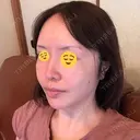 糸リフト / 骨切り（あご） / 骨削り（エラ） / 骨削り（頬） / 脂肪吸引（顔） / 輪郭修正 / 脂肪注入（額） / 脂肪注入（輪郭） / ハイフ（顔） GIRIN（ギリン）美容外科 AFTER サムネイル用