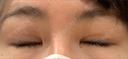 目頭切開 アロマ美容外科クリニック DAY 17 サムネイル用