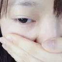 二重埋没 かわた美容クリニック DAY 192 サムネイル用