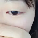二重埋没 かわた美容クリニック DAY 192 サムネイル用