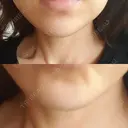 ボトックス（あご） 品川美容外科 仙台院 DAY 11 サムネイル用