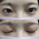 二重埋没 かわた美容クリニック DAY 197 サムネイル用