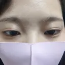 二重埋没 かわた美容クリニック DAY 197 サムネイル用