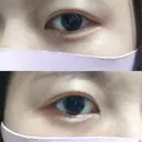二重埋没 かわた美容クリニック DAY 197 サムネイル用