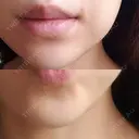 ボトックス（あご） 品川美容外科 仙台院 DAY 13 サムネイル用