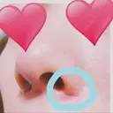 鼻尖形成（切開） / 小鼻縮小（切開） / 軟骨移植 湘南美容クリニック 船橋院 DAY 61 サムネイル用