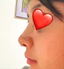 隆鼻術 / 鼻尖形成（切開） / 鼻中隔延長（切開） / 軟骨移植 グロービー美容整形外科 DAY 4 サムネイル用