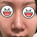 鼻尖形成（切開） / ヒアルロン酸注入（鼻） 東京ヒルズクリニック 新宿院 DAY 57 サムネイル用