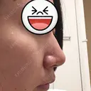 鼻尖形成（切開） / ヒアルロン酸注入（鼻） 東京ヒルズクリニック 新宿院 DAY 57 サムネイル用