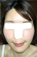 糸リフト / バッカルファット除去 / 脂肪吸引（顔） / ボトックス（エラ・小顔） 湘南美容クリニック 秋葉原院 DAY 85 サムネイル用