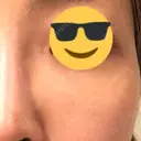 シミ取りレーザー / 美白レーザー / YAGレーザー / その他（目元） YAG BEAUTY CLINIC TOKYO  DAY 5 サムネイル用