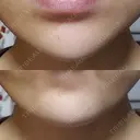 ボトックス（あご） 品川美容外科 仙台院 AFTER サムネイル用