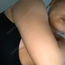 脂肪溶解注射（顔） / 脂肪溶解注射（二の腕） / ボトックス（肩） / その他（ボディ） 品川スキンクリニック京都院 DAY 132 サムネイル用