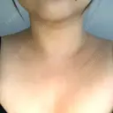 脂肪溶解注射（顔） / 脂肪溶解注射（二の腕） / ボトックス（肩） / その他（ボディ） 品川スキンクリニック京都院 DAY 132 サムネイル用