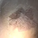 その他（胸） 三輪皮フ科形成外科 DAY 3 サムネイル用