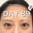 二重切開 BIANCA銀座 DAY 89 サムネイル用